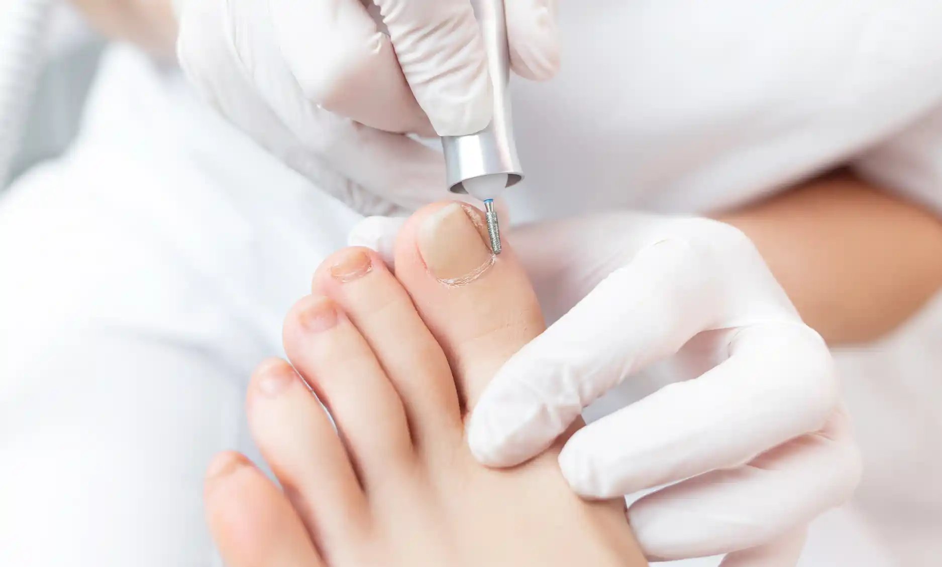 FACA - Ingrown toenail